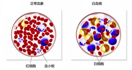 甲醛檢測機構告訴你甲醛與白血病之間有著怎樣的聯系